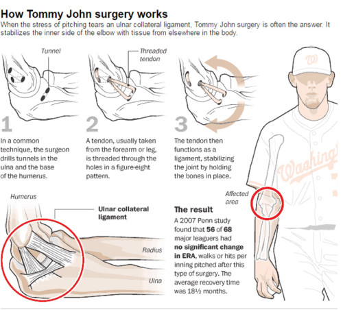 Pitcher performance varies following Tommy John surgery